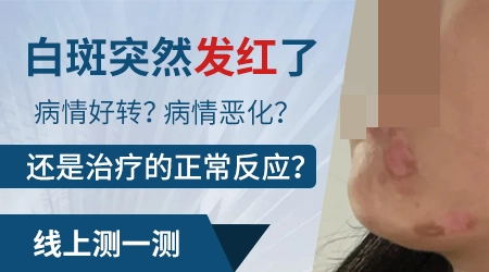 白癜风泛红是要恢复吗