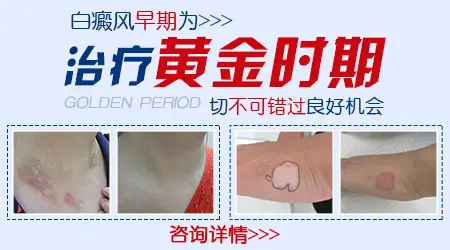 白癜风初期有哪些明显症状与其他白斑不同