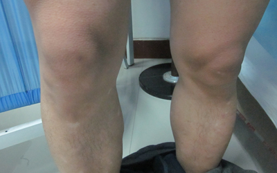 膝盖下方突然长了一块白斑很光滑是什么