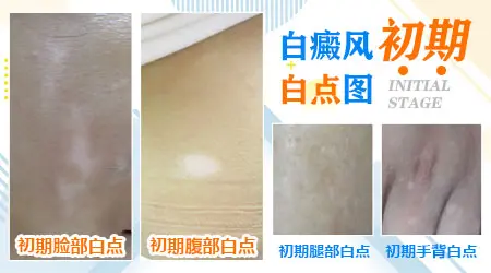 皮肤上白点图片 [中医] 怎么治疗皮肤白点