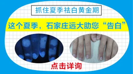 白癜风夏季治疗优势 治疗白斑的方法