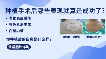 黑色素种植手术治白癜风花钱多不多