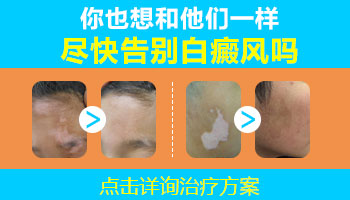 脸上胳膊上都是白癜风能治好吗