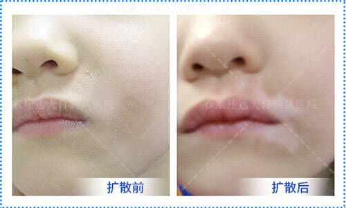 新发现的白斑长在嘴唇下方汗毛都白了