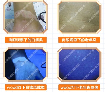 伍德灯检查身上的白斑颜色对照