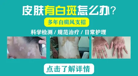 长在指甲周围的白癜风要怎么处理