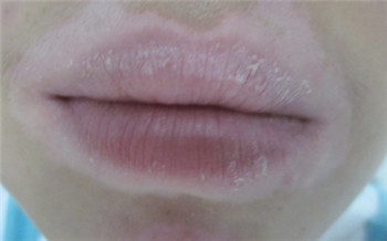 嘴唇一圈白斑感觉还在扩散药物治疗能治好吗