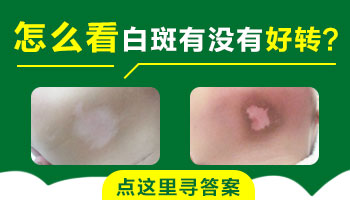 烫伤引起的皮肤变白一定是白癜风吗