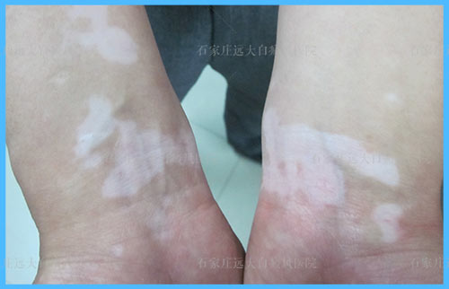 手腕上面莫名出现白色斑点是怎么了