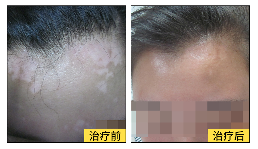 白癜风的并发症有哪些？