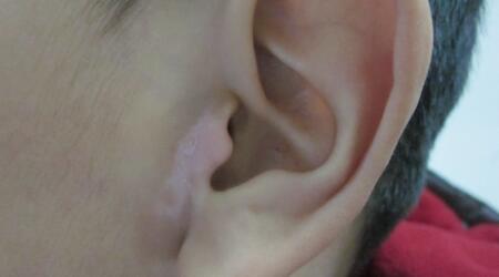 耳根长白点是什么原因 白点是什么