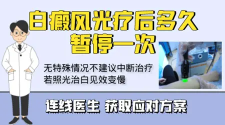 白癜风窄谱uvb光疗中途停了会影响效果吗