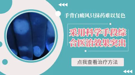 手部白癜风涂抹什么药效果好