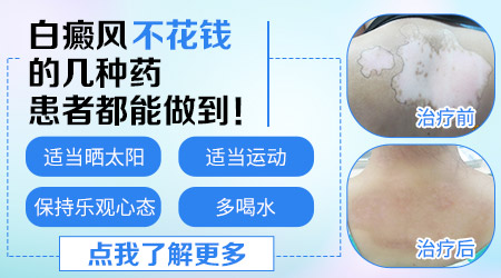 男朋友长了白癜风怎么办 能治好吗