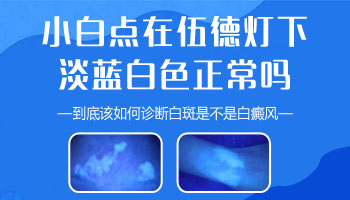 伍德灯照白斑显示淡蓝白色是早期白癜风吗