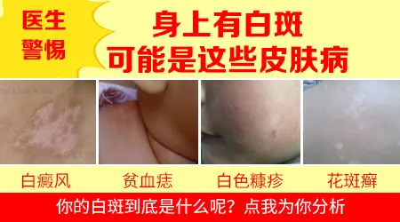 小孩手背上突然出现一块白斑