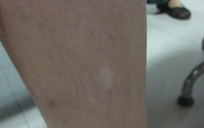 大腿皮肤白斑 初期白斑图片
