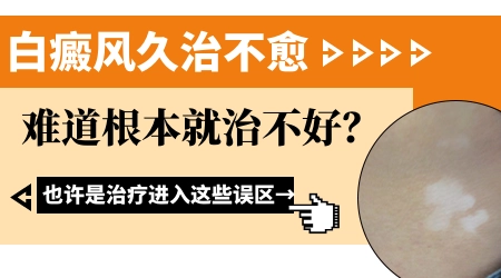 脸上白斑是白癜风吗 白癜风好治疗吗