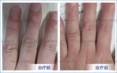 中药液可以治疗白癜风吗