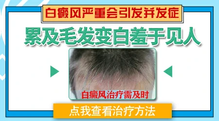 白癜风白斑里的毛发变白了是怎么回事