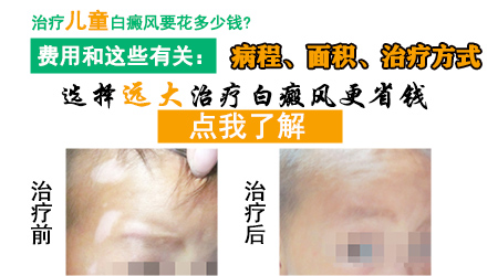 儿童白癜风治好花钱多吗