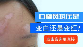 白斑按压怎么辨别是不是白癜风