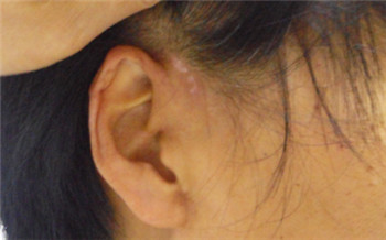 女性面部初期白斑症状图片