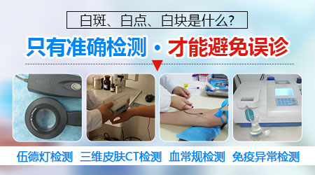 鼻子旁边白斑做过伍德灯不确定是白癜风