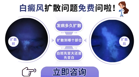 身上白点越多是不是发展的越快