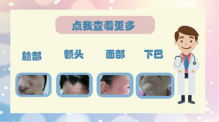 7岁小孩右脸眼角白块越来越大