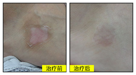 白癜风照一次308激光的价格是多少