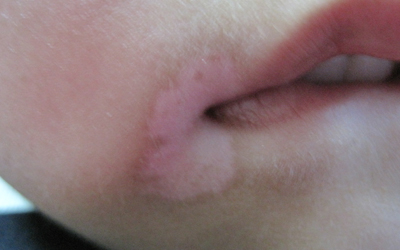 6岁小孩嘴唇上长白斑图片