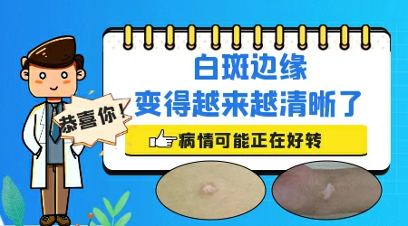 白癜风治疗后边界清晰代表什么