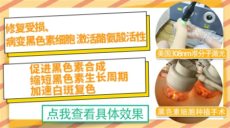激光治疗白斑吗 308照白斑效果图