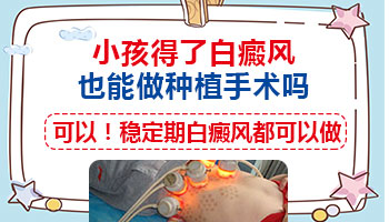黑色素培植治疗儿童耳朵白癜风可以吗