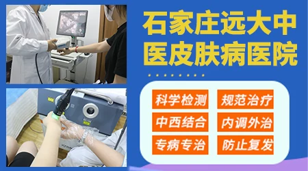 孩子脸上的白斑边界模糊是什么问题