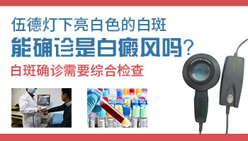 伍德氏灯检查白点是亮白色是不是白癜风