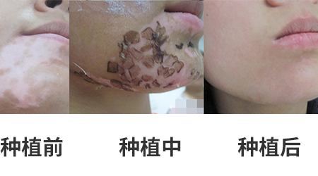 放寒假,祛白斑!7天唤醒黑色素!白斑强化诊疗进行中!