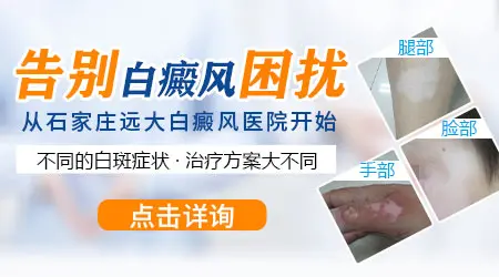 阴茎白癜风怎么治