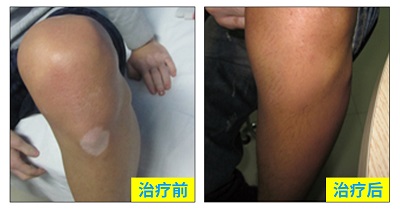 治疗白癜风311和308的区别