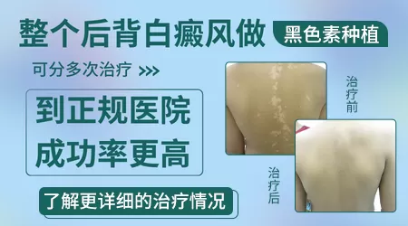 邢台哪个医院做黑色素移植手术好