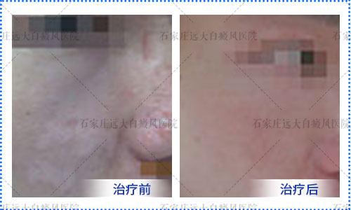 邢台哪个医院治疗白癜风效果好