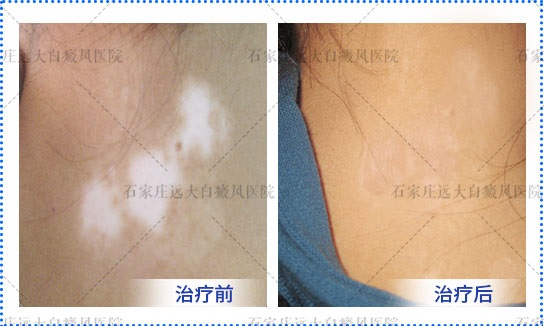 在锁骨的位置出现白斑怎么回事