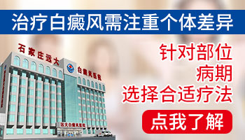 治疗白癜风之前 一定要先看这篇文章