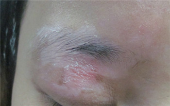 眉毛上面白癜风初期图片