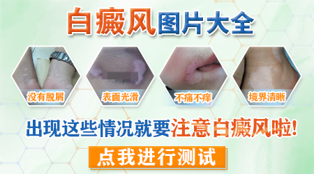 儿童白斑和白癜风区别是什么样子