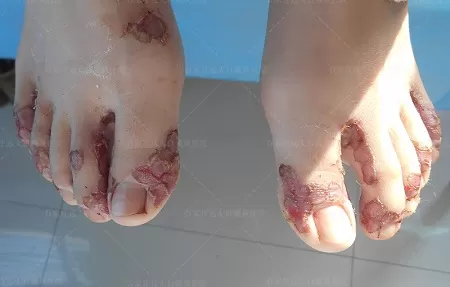 白癜风脚面植皮成功图 白癜风种植后的恢复过程