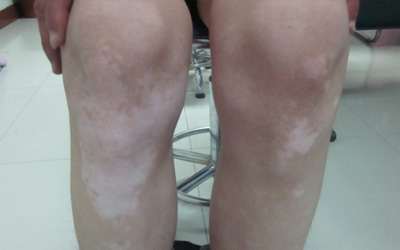 膝盖处有一不规则形状的白斑是什么