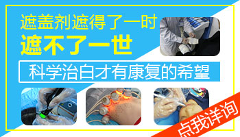 手上出现了白癜风可以使用遮盖剂吗
