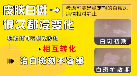 孩子身上白斑一年没变化